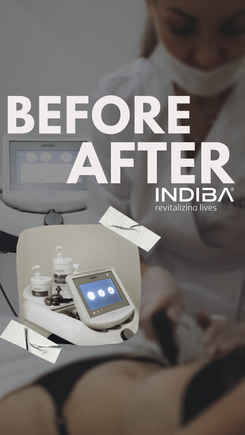 INDIBA® Deep Care - результати до та після